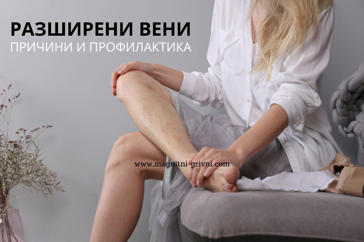 Ето кои са причините за поява на Разширени вени и какви Превантивни мерки да вземем!